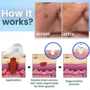 Cvreoz® Nano-Micro Needle Skin Tags Removal Patches  | No More Hiding that Skin!💕