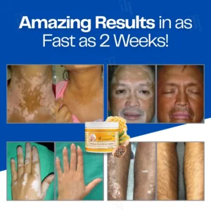 Cvreoz® VitiClear Bee Venom Cream | No More Hiding that Skin!💕