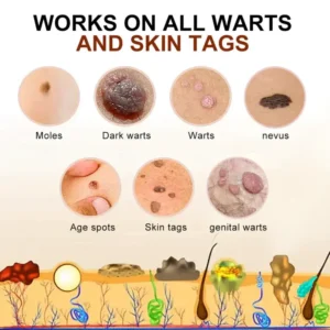 ONLY 50 jars left! Cvreoz® PRO Bee Venom Mole and Wart Treatment Cream