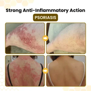 NATRAVOR® PsoriaSoothe Bee Venom Skin-Restoration Cream