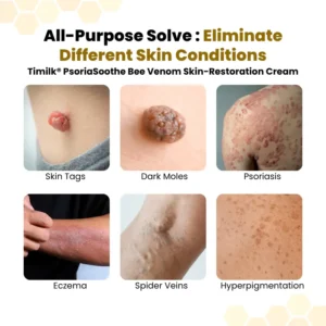 NATRAVOR® PsoriaSoothe Bee Venom Skin-Restoration Cream