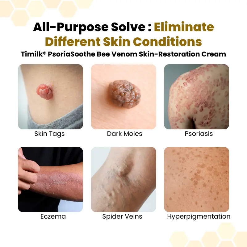 NATRAVOR® PsoriaSoothe Bee Venom Skin-Restoration Cream