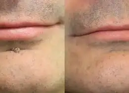 NATRAVOR®2-in-1 Microneedle & Hydrocolloid Patch🍀| Removes Raised Moles, Acne, Flat Warts & Skin Tags | Helps Improve Wrinkles, Scars & Blemishes | Invisible Patches for Face & Body