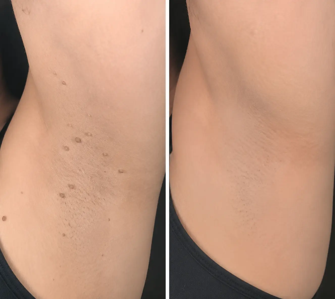 NATRAVOR®2-in-1 Microneedle & Hydrocolloid Patch🍀| Removes Raised Moles, Acne, Flat Warts & Skin Tags | Helps Improve Wrinkles, Scars & Blemishes | Invisible Patches for Face & Body