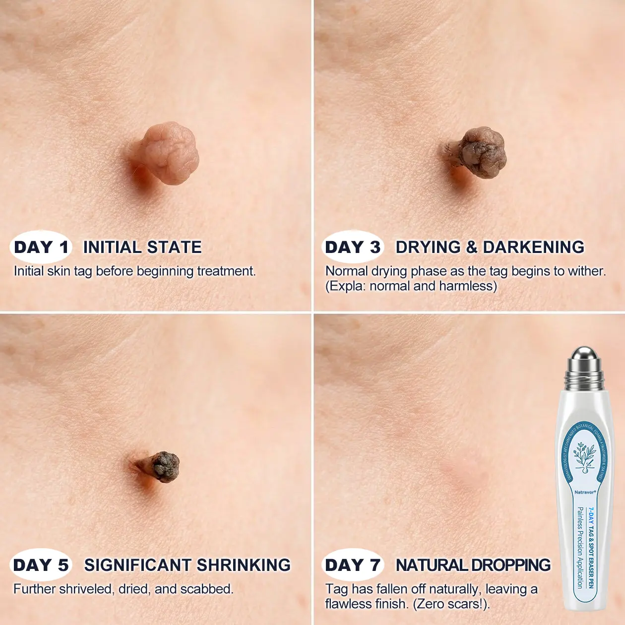 Natravor®Dermatology-Inspired Skin Care System Skin Tag & Spot Appearance Support Pen