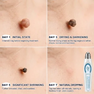 𝐎𝐟𝐟𝐢𝐜𝐢𝐚𝐥 𝐁𝐫𝐚𝐧𝐝 𝐒𝐭𝐨𝐫𝐞 |✅🎉Natravor® 7-Day Tag & Spot Eraser Rollerball |
 – US
