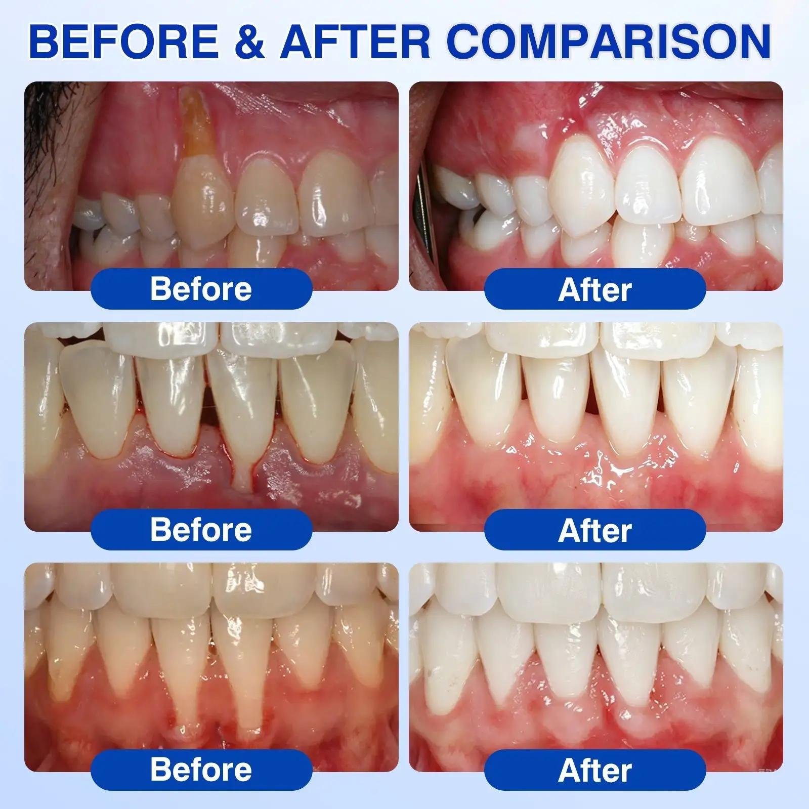 ๐บ๐ธ๐
๐ฆท๐ซ๐๐๐ญ๐ซ๐๐ฏ๐จ๐ซยฎ GumRevive Periodontal Repair Gel
โ Wepriz