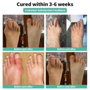 🏅Natravor® Relief Botanical Bunion Comfort Patcht👠💃