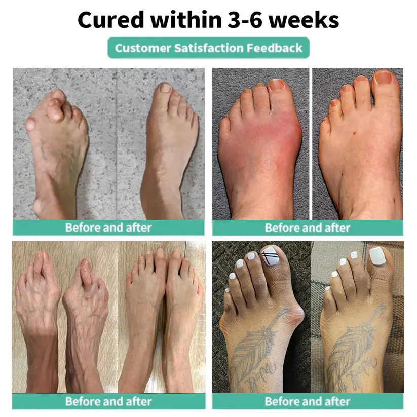 🏅Natravor® Relief Botanical Bunion Comfort Patcht👠💃